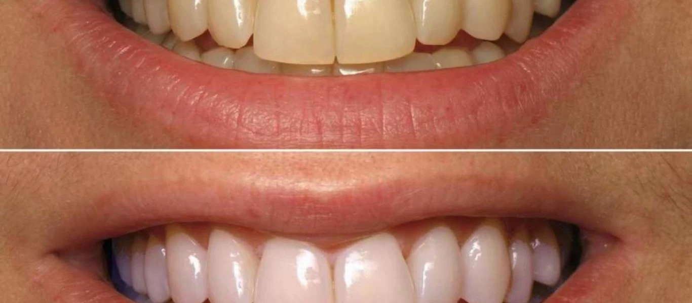 Κίτρινα δόντια: Πως να τα αντιμετωπίσετε εύκολα στο σπίτι